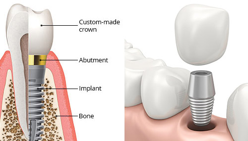 Dental Implants in Merced, CA